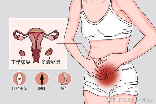 竞博JBO官网多囊卵巢在不同时期应该如何调理？(图1)